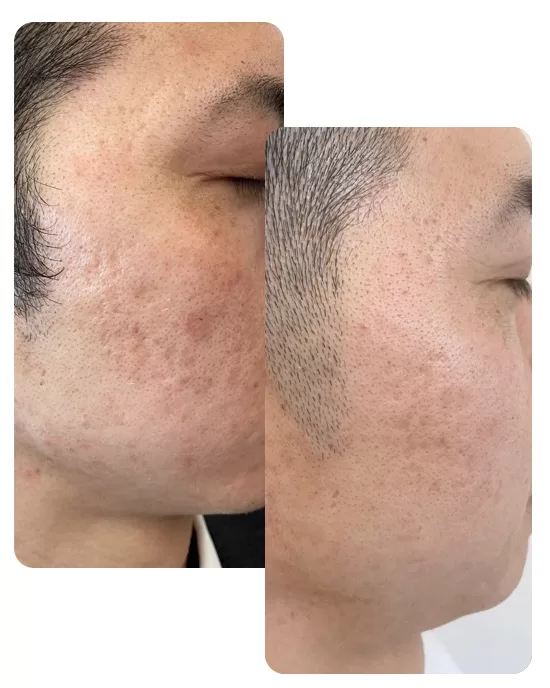 光フォトフェイシャル