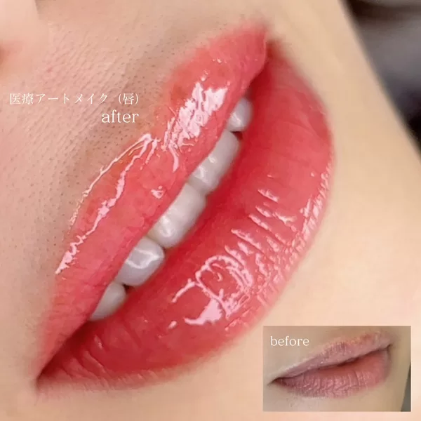 医療アートメイク・唇